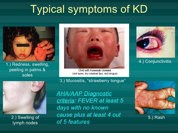 Kawasaki Coronary Artery Disease Kawasaki Coronary Artery Disease