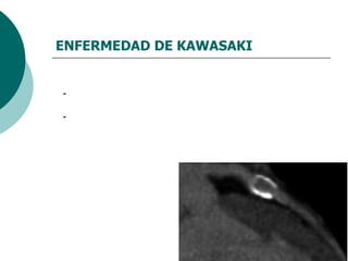 ENFERMEDAD DE KAWASAKI Identificación del adulto con antecedente de EK: Antecedentes de enfermedad febril con signos clínicos sugestivos. TAC multicorte e índices de calcificación coronaria anormales en el adulto joven y perfil bajo para ateroesclerosis - RM permite determinar daño estructural miocárdico 