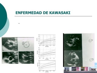 ENFERMEDAD DE KAWASAKI Ecocardiograma permite observar diámetro interno  coronario de la DA y CD  - Valor Z en normograma 