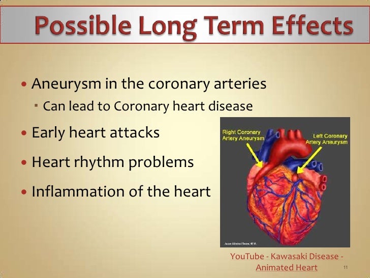 kawasaki disease ppt Recognition and management of kawasaki disease | cmaj.