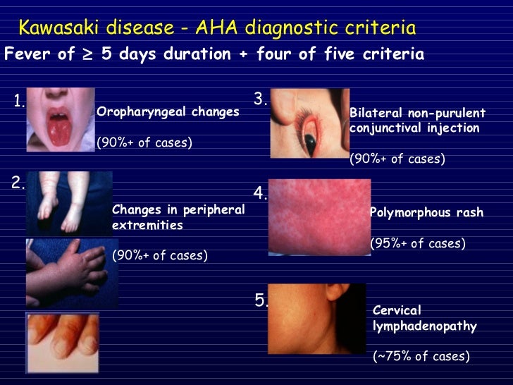 kawasaki disease ppt Ppt what is kawasaki disease? Powerpoint presentation id:2569620.
