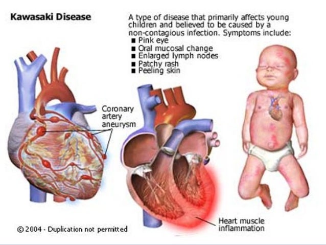 Immunization After Kawasaki Disease Immunization After Kawasaki Disease