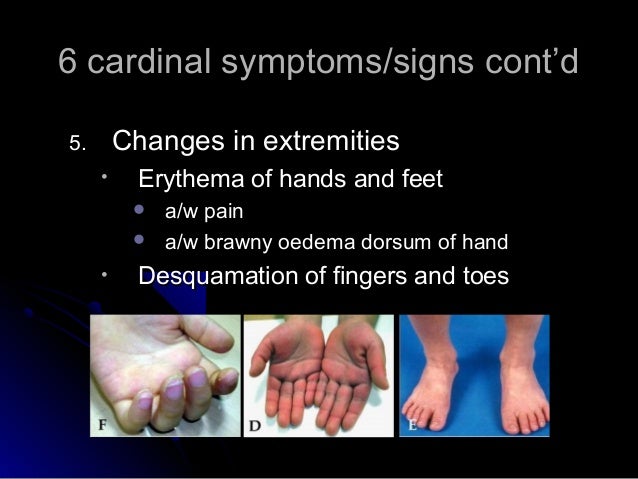 Kawasaki Disease Desquamation Kawasaki Disease Desquamation