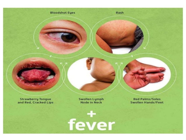 Kawasaki Fever Duration Kawasaki Fever Duration