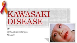 KAWASAKI
DISEASE
By
N.S.Amitha Natarajan
Group 3
 