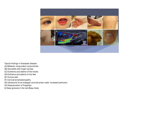 Typical
fi
ndings in Kawasaki disease
(A) Bilateral, nonpurulent conjunctivitis
(B) Stomatitis with bright red lips
(C) Erythema and edema of the hands
(D) Erythema and edema of the feet
(E) Truncal rash
(F) Cervical lymphadenopathy
(G) Ultrasound of an enlarged cervical lymph node: increased perfusion
(H) Desquamation of
fi
ngertips
(I) Deep grooves in the nail (Beau lines)
 