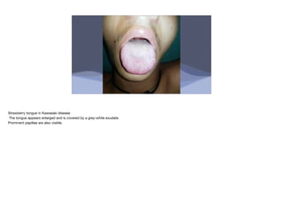 Strawberry tongue in Kawasaki disease
The tongue appears enlarged and is covered by a grey-white exudate.
Prominent papillae are also visible.
 
