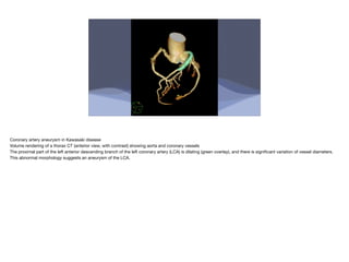 Coronary artery aneurysm in Kawasaki disease
Volume rendering of a thorax CT (anterior view, with contrast) showing aorta and coronary vessels
The proximal part of the left anterior descending branch of the left coronary artery (LCA) is dilating (green overlay), and there is signi
fi
cant variation of vessel diameters.
This abnormal morphology suggests an aneurysm of the LCA.
 