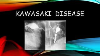 KAWASAKI DISEASE
 