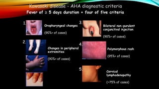 Kawasaki disease - AHA diagnostic criteria
Fever of  5 days duration + four of five criteria
Oropharyngeal changes
(90%+ of cases)
1.
Changes in peripheral
extremities
(90%+ of cases)
2.
Cervical
lymphadenopathy
(~75% of cases)
5.
Polymorphous rash
(95%+ of cases)
4.
Bilateral non-purulent
conjunctival injection
(90%+ of cases)
3.
 