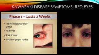 KAWASAKI DISEASE SYMPTOMS: RED EYES
 