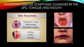 KAWASAKI DISEASE SYMPTOMS: CHANGES IN THE
LIPS, TONGUE AND MOUTH
 