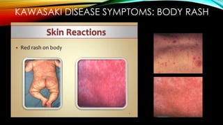 KAWASAKI DISEASE SYMPTOMS: BODY RASH
 