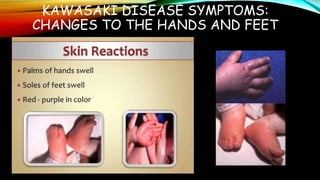 KAWASAKI DISEASE SYMPTOMS:
CHANGES TO THE HANDS AND FEET
 