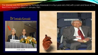 The disease was first reported by Tomisaku Kawasaki in a four-year-old child with a rash and fever at the
Red Cross Hospital in Tokyo in January 1961.
 