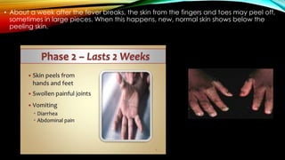• About a week after the fever breaks, the skin from the fingers and toes may peel off,
sometimes in large pieces. When this happens, new, normal skin shows below the
peeling skin.
 