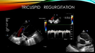 TRICUSPID REGURGITATION
 