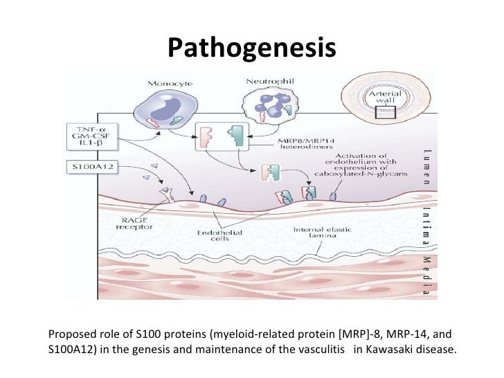 Kawasaki Disease Pathogenesis Kawasaki Disease Pathogenesis