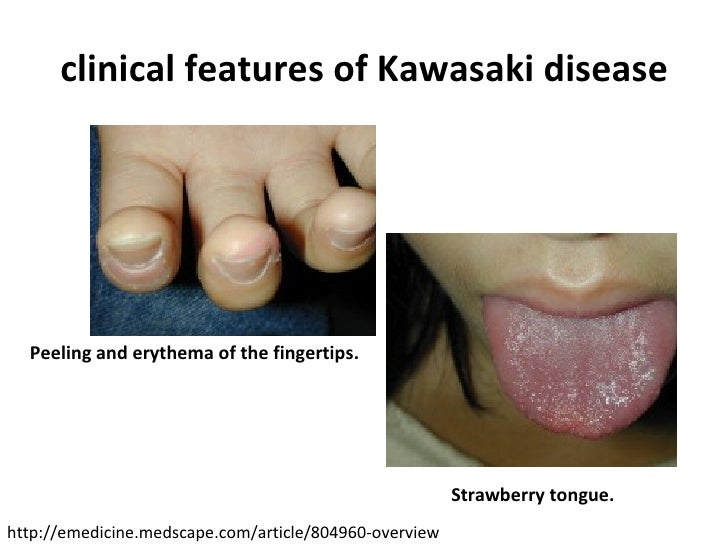 Kawasaki Disease Emedicine Kawasaki Disease Emedicine
