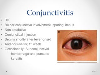 Bulbar Conjunctivitis Kawasaki Bulbar Conjunctivitis Kawasaki