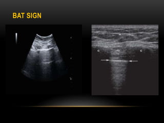 Chest ultrasound.pptx