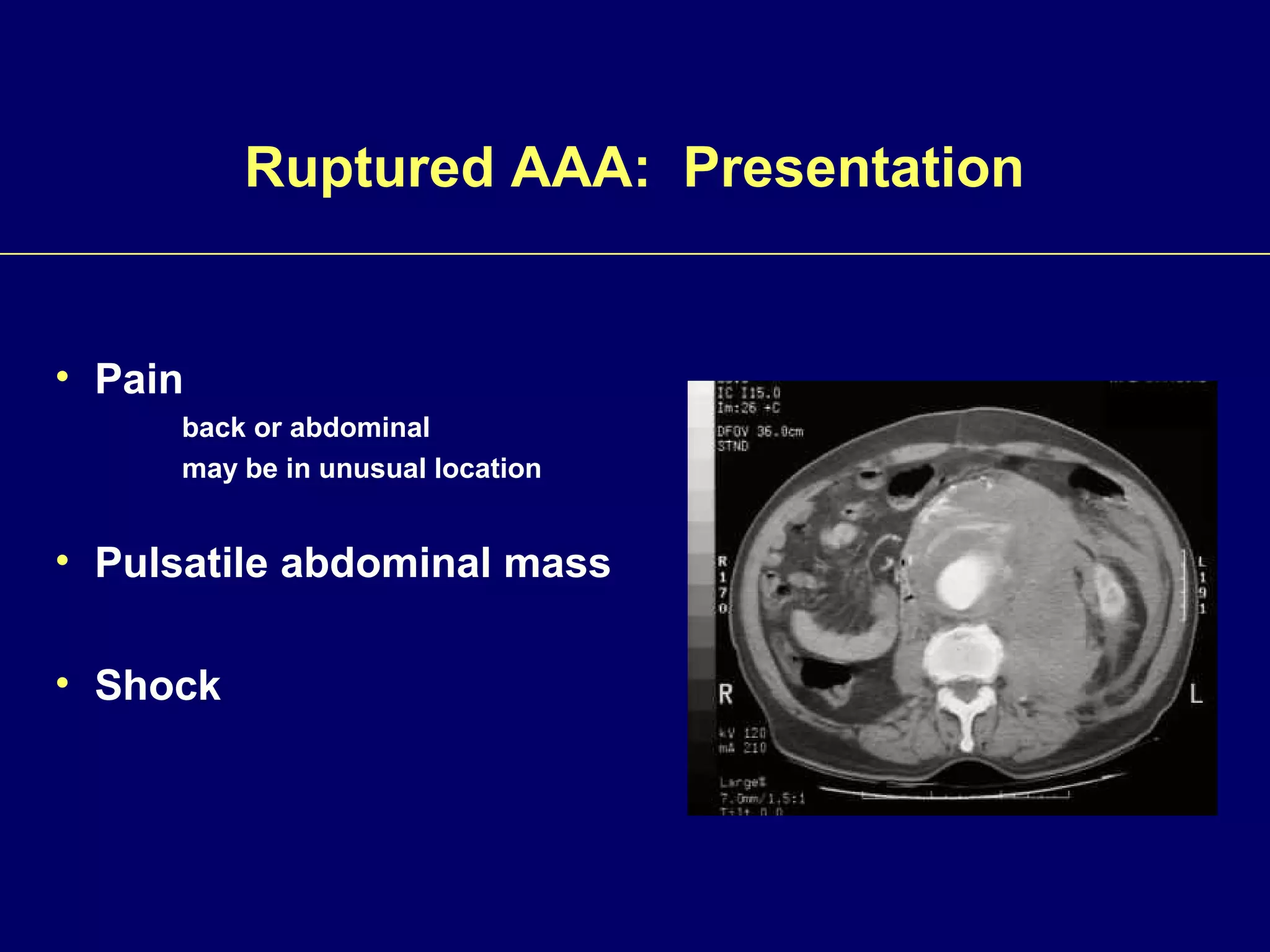 Abdominal Aortic and Thoracic Aneurysms | PPT