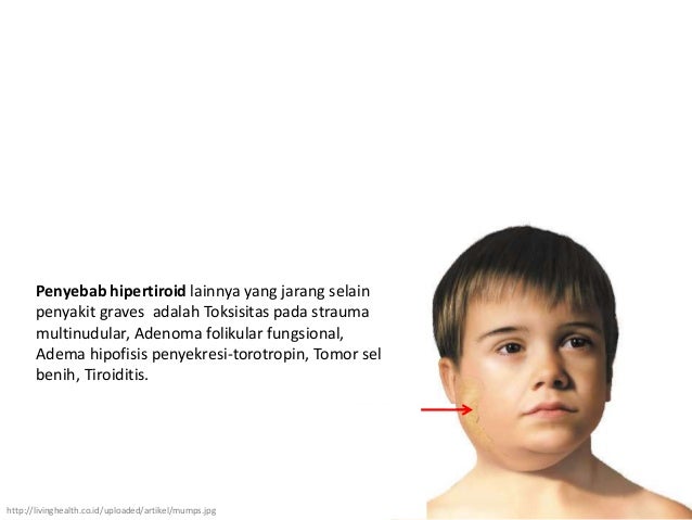 Asuhan Keperawatan Hipertiroid