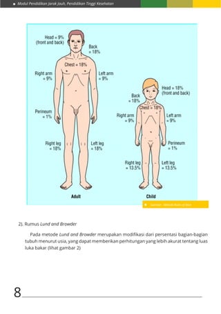 Modul Pendidikan Jarak Jauh, Pendidikan Tinggi Kesehatan
8
		
2). Rumus Lund and Browder
Pada metode Lund and Browder merupakan modifikasi dari persentasi bagian-bagian
tubuh menurut usia, yang dapat memberikan perhitungan yang lebih akurat tentang luas
luka bakar (lihat gambar 2)
Gambar : Metode Rules of Nine
 