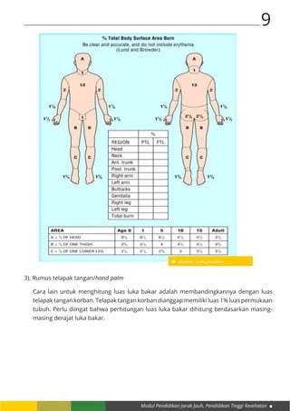 Modul Pendidikan Jarak Jauh, Pendidikan Tinggi Kesehatan
9
	
3). Rumus telapak tangan/hand palm
Cara lain untuk menghitung luas luka bakar adalah membandingkannya dengan luas
telapak tangan korban. Telapak tangan korban dianggap memiliki luas 1% luas permukaan
tubuh. Perlu diingat bahwa perhitungan luas luka bakar dihitung berdasarkan masing-
masing derajat luka bakar.
Gambar : Luas Luka Bakar
 