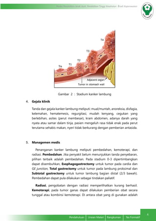 4
Modul Pendidikan Jarak Jauh, Pendidikan Tinggi Kesehatan Prodi Keperawatan
Pendahuluan	 Uraian Materi	 Rangkuman	 Tes Formatif
Gambar 2 : Stadium kanker lambung
4.	 Gejala klinik
Tanda dan gejala kanker lambung meliputi: mual/muntah, anoreksia, disfagia,
kelemahan, hematemesis, regurgitasi, mudah kenyang, cegukan yang
berlebihan, asites (perut membesar), kram abdomen, adanya darah yang
nyata atau samar dalam tinja, pasien mengeluh rasa tidak enak pada perut
terutama sehabis makan, nyeri tidak berkurang dengan pemberian antasida.
5.	 Managemen medis
Penanganan kanker lambung meliputi pembedahan, kemoterapi, dan
radiasi. Pembedahan. Jika penyakit belum menunjukkan tanda penyebaran,
pilihan terbaik adalah pembedahan. Pada stadium 0-3 dipertimbangkan
dapat disembuhkan, Esophagogastrectomy untuk tumor pada cardia dan
GE junction, Total gastrectomy untuk tumor pada lambung proksimal dan
Subtotal gastrectomy untuk tumor lambung bagian distal (2/3 bawah).
Pembedahan dapat pula dilakukan sebagai tindakan paliatif.
Radiasi, pengobatan dengan radiasi memperlihatkan kurang berhasil.
Kemoterapi, pada tumor ganas dapat dilakukan pemberian obat secara
tunggal atau kombinsi kemoterapi. Di antara obat yang di gunakan adalah
 