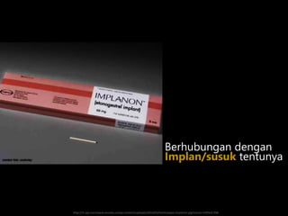 http://i1.wp.com/www.enciety.co/wp-content/uploads/2014/03/kontrasepsi-implanon.jpg?resize=530%2C398
Berhubungan dengan
Implan/susuk tentunya
 