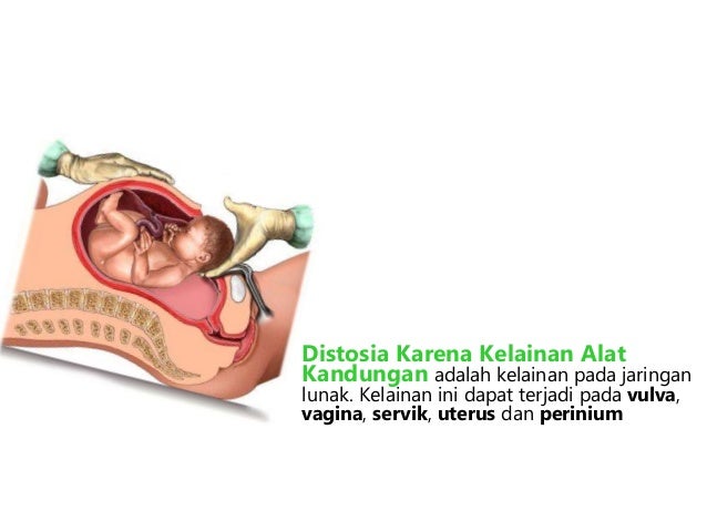 DYSTOCIA ALAT KANDUNGAN PDF DYSTOCIA ALAT KANDUNGAN PDF