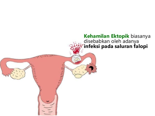 KB 2 Komplikasi Kehamilan