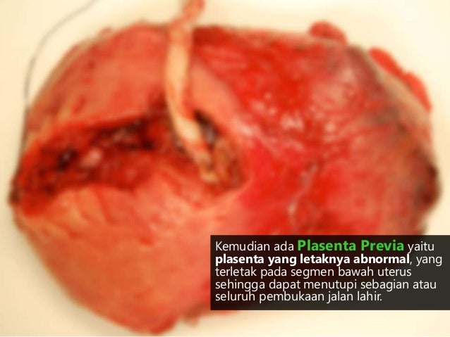 KB 2 Komplikasi Kehamilan