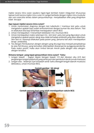 59
Modul Pendidikan Jarak Jauh Pendidikan Tinggi Kesehatan
injeksi secara intra cutan saudara ingat-ingat kembali materi integumen khususnya
lapisan kulit karena injeksi intra cutan ini sangat berbeda dengan injeksi intra muskular
dan sub cutan,bila terlalu dalam penyuntikannya menyebabkan efek yang diinginkan
tidak tercapai
Apa tujuan injeksi secara intra cutan?
1.	Untuk menentukan diagnosa dengan test tuberkulin / mantoux test yaitu untuk
mengetahui apakah bayi sudah terkontaminasi dengan kuman tbc atau belum. Test
ini dilakukan bila bayi terlambat mendapatkan vaksin BCG
2.	 Untuk mendapatkan / menambah kekebalan mis: imunisasi BCG
3.	 Untuk mendapatkan reaksi setempat mis : skin test/ yaitu test yang digunakan untuk
mengetahui apakah pasien alergi atau tidak terhadap antibiotik yang akan diberikan.
Skin test ini biasanya dilakukan pada pasien yang pertama kali akan mendapatkan
terapi antibiotika.
4.	 Tes Alergen Pembubuhan alergen-alergen yang dicurigai bisa menjadi penyebabnya
ke atas foil khusus, yang kemudian ditempelkan (biasanya) ke punggung penderita.
Pada reaksi positif, maka akan timbul bercak merah pada alergen atau alergen-
alergen tersebut.
Dimana tempat yang tepat penyuntikan intra cutan? Yaitu:
1.	Lengan bawah : bagian depan leengan bawah 1/3 dari lekukan siku (2/3 dari
pergelangan tangan) pada kulit yang sehat jauh dari pembuluh darah (unutk mantuox)
2.	 Lengan atas : letaknya 3 jari di bawah sendi bahu ditengah-tengah daerah muskulus
deltoideus, untuk imunisasi BCG.
Contoh gambar Uji alergi
Contoh seorang bayi yang telah mendapatkan vakcin BCG
 