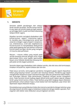 Modul Pendidikan Jarak Jauh Pendidikan Tinggi Kesehatan
3
Uraian
Materi
1.	SERVISITIS
Servisitis adalah peradangan dari selaput
lendir kanalis servikalis. Serviks hanya memili-
ki satu lapis sel silindris pada jaringan epiteln-
ya sehingga lebih mudah terinfeksi dibanding
selaput lendir vagina.
Kejadian servisitis seringkali disebabkan oleh
kuman-kuman seperti : trikomonas vagina-
lis, kandida atau mikroorganisme aerob dan
anaerob endogen vagina (seperti streptococ-
cus, enterecoccus, e.coli dan stapilococcus).
Kuman-kuman ini menyebabkan deskuamasi
pada epitel gepeng dan perubahan imflamasi
kromik dalam jaringan serviks yang mengala-
mi trauma atau perlukaan
Macam – macam infeksi yang terjadi pada
serviks biasanya dimulai dengan erosi ringan
(permukaan licin), erosi kapiler (permukaan
kasar), erosi folikuler (kistik) dan biasanya ter-
jadi pada serviks bagian posterior.
Servisitis dapat juga disebabkan oleh robekan serviks, alat-alat atau alat kontrasepsi,
tindakan intrauterine, seperti dilatasi dan lain-lain
Pada kasus servisitis, kemungkinan penderita mengalami gejala seperti Keputihan
hebat yang biasanya kental / purulent dan biasanya berbau. Penderita juga dapat
mengeluhkan dispareuni (nyeri saat berhubungan seksual), perdarahan data melaku-
kan hubungan seksual. Pada pemeriksaan inspekulo tampak serviks mengalami
erosi. Pada servisitis kronik kadang dapat dilihat bintik putih dalam daerah selaput
lendir yang merah karena infeksi. Pada fasilitas yang lebih lengkap dapat dilakukan
pemeriksaan untuk sediaan hapus untuk biakan dan test kepekaan, pap smear dan
diperlukan dapat dilakukan biopsy.
Penatalaksanaan yang dilakukan bidan jika menemui penderita dengan keluhan yang
dicurigai kearah servisitis segera melakukan kolaborasi dengan dokter spesialis. Pen-
anganan oleh dokter akan dilakukan sesuai tingkatan servisitis
 