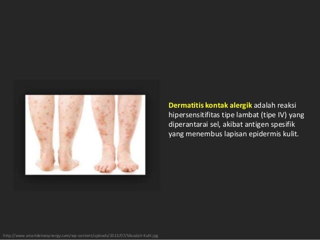 ASUHAN KEPERAWATAN PASIEN DERMATIS KONTAK