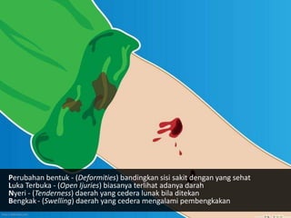 Perubahan bentuk - (Deformities) bandingkan sisi sakit dengan yang sehat
Luka Terbuka - (Open Ijuries) biasanya terlihat adanya darah
Nyeri - (Tenderness) daerah yang cedera lunak bila ditekan
Bengkak - (Swelling) daerah yang cedera mengalami pembengkakan
http://wikihow.com
 