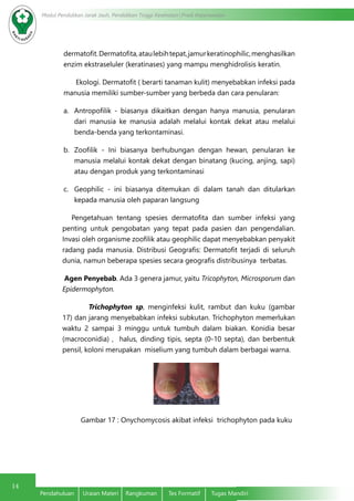 14
Modul Pendidikan Jarak Jauh, Pendidikan Tinggi Kesehatan Prodi Keperawatan
Pendahuluan	 Uraian Materi	 Rangkuman	 Tes Formatif	 Tugas Mandiri
dermatofit.Dermatofita,ataulebihtepat,jamurkeratinophilic,menghasilkan
enzim ekstraseluler (keratinases) yang mampu menghidrolisis keratin.
Ekologi. Dermatofit ( berarti tanaman kulit) menyebabkan infeksi pada
manusia memiliki sumber-sumber yang berbeda dan cara penularan:
a.	 Antropofilik - biasanya dikaitkan dengan hanya manusia, penularan
dari manusia ke manusia adalah melalui kontak dekat atau melalui
benda-benda yang terkontaminasi.
b.	 Zoofilik - Ini biasanya berhubungan dengan hewan, penularan ke
manusia melalui kontak dekat dengan binatang (kucing, anjing, sapi)
atau dengan produk yang terkontaminasi
c.	 Geophilic - ini biasanya ditemukan di dalam tanah dan ditularkan
kepada manusia oleh paparan langsung
Pengetahuan tentang spesies dermatofita dan sumber infeksi yang
penting untuk pengobatan yang tepat pada pasien dan pengendalian.
Invasi oleh organisme zoofilik atau geophilic dapat menyebabkan penyakit
radang pada manusia. Distribusi Geografis: Dermatofit terjadi di seluruh
dunia, namun beberapa spesies secara geografis distribusinya terbatas.
Agen Penyebab. Ada 3 genera jamur, yaitu Tricophyton, Microsporum dan
Epidermophyton.
	 Trichophyton sp, menginfeksi kulit, rambut dan kuku (gambar
17) dan jarang menyebabkan infeksi subkutan. Trichophyton memerlukan
waktu 2 sampai 3 minggu untuk tumbuh dalam biakan. Konidia besar
(macroconidia) , halus, dinding tipis, septa (0-10 septa), dan berbentuk
pensil, koloni merupakan miselium yang tumbuh dalam berbagai warna.
Gambar 17 : Onychomycosis akibat infeksi trichophyton pada kuku
 