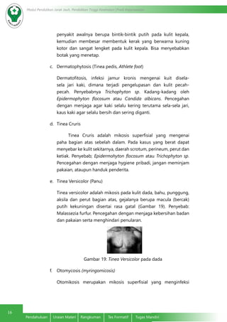 16
Modul Pendidikan Jarak Jauh, Pendidikan Tinggi Kesehatan Prodi Keperawatan
Pendahuluan	 Uraian Materi	 Rangkuman	 Tes Formatif	 Tugas Mandiri
penyakit awalnya berupa bintik-bintik putih pada kulit kepala,
kemudian membesar membentuk kerak yang berwarna kuning
kotor dan sangat lengket pada kulit kepala. Bisa menyebabkan
botak yang menetap.
c.	 Dermatophytosis (Tinea pedis, Athlete foot)
Dermatofitosis, infeksi jamur kronis mengenai kuit disela-
sela jari kaki, dimana terjadi pengelupasan dan kulit pecah-
pecah. Penyebabnya Trichophyton sp. Kadang-kadang oleh
Epidermophyton flocosum atau Candida albicans. Pencegahan
dengan menjaga agar kaki selalu kering terutama sela-sela jari,
kaus kaki agar selalu bersih dan sering diganti.
d.	 Tinea Cruris
	 Tinea Cruris adalah mikosis superfisial yang mengenai
paha bagian atas sebelah dalam. Pada kasus yang berat dapat
menyebar ke kulit sekitarnya, daerah scrotum, perineum, perut dan
ketiak. Penyebab; Epidermohyton flocosum atau Trichophyton sp.
Pencegahan dengan menjaga hygiene pribadi, jangan meminjam
pakaian, ataupun handuk penderita.
e.	 Tinea Versicolor (Panu)
Tinea versicolor adalah mikosis pada kulit dada, bahu, punggung,
aksila dan perut bagian atas, gejalanya berupa macula (bercak)
putih kekuningan disertai rasa gatal (Gambar 19). Penyebab:
Malassezia furfur. Pencegahan dengan menjaga kebersihan badan
dan pakaian serta menghindari penularan.
Gambar 19: Tinea Versicolor pada dada
f.	 Otomycosis (myringomicosis)
Otomikosis merupakan mikosis superfisial yang menginfeksi
 