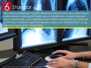 Standar 6.26Jika hasil bakteriologis negatif, diagnosis tuberkulosis harus didasarkan
pada kelainan radiografi toraks sesuai tuberkulosis, riwayat terpajan
kasus tuberkulosis yang menular, bukti infeksi tuberkulosis (uji tuberkulin
positif atau interferon gamma release assay) dan temuan klinis yang
mendukung ke arah tuberkulosis.
http://www.bccdc.ca/NR/rdonlyres/35F10D60-AA8B-438C-B4E9-C85F6F61B6D7/0/iStock_000005176287Medium_xray_pc_screen.jpg
 