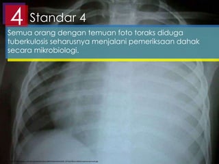 Standar 44Semua orang dengan temuan foto toraks diduga
tuberkulosis seharusnya menjalani pemeriksaan dahak
secara mikrobiologi.
http://2.bp.blogspot.com/-jlCeUpoHWSQ/UQaUuL0kKYI/AAAAAAAAAD8/_K6T3aCFBKU/s1600/empyema+pra+wsd.jpg
 