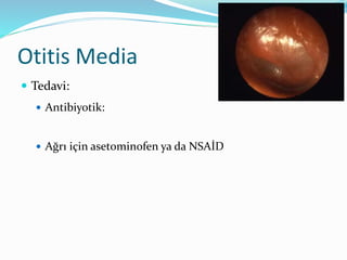Otitis Media
 Komplikasyonlar:
 Ekstrakranial komplikasyonlar
 Akut mastoidit
 Kolesteatoma
 İntrakranial komplikasyo...