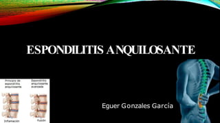 ESPONDILITIS ANQUILOSANTE
Eguer Gonzales García
 