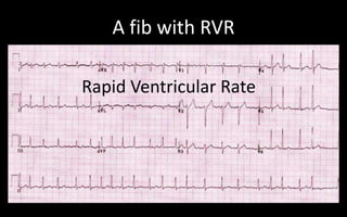 King Bay ECG/STEMI | PPTX