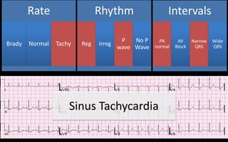 King Bay ECG/STEMI | PPTX