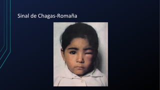 Sinal de Chagas-Romaña
 
