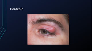 Hordéolo
 