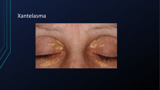 Xantelasma
 