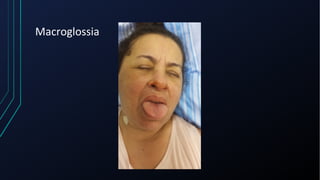 Macroglossia
 